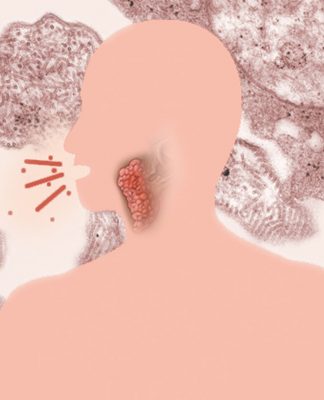 Proteção contra caxumba pode diminuir ao longo dos anos