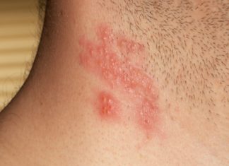 Vírus do herpes-zoster está presente em 95% das pessoas